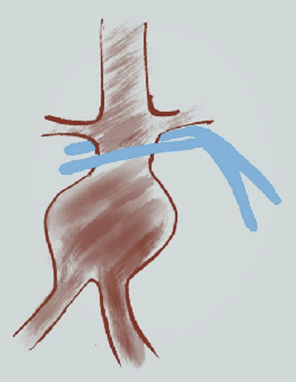 The Aortic Clamp